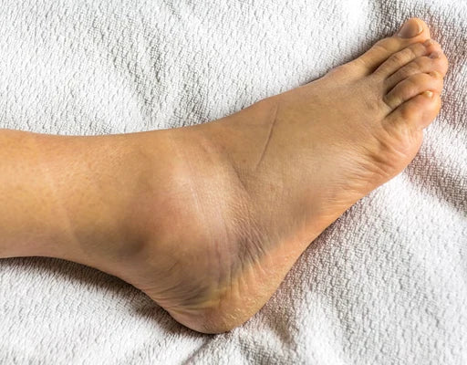 Swollen ankles