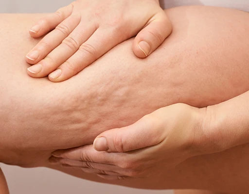 Cellulite appearance